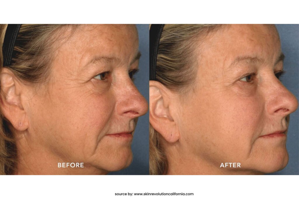 before after pico laser