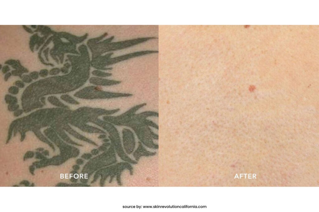 before after pico laser