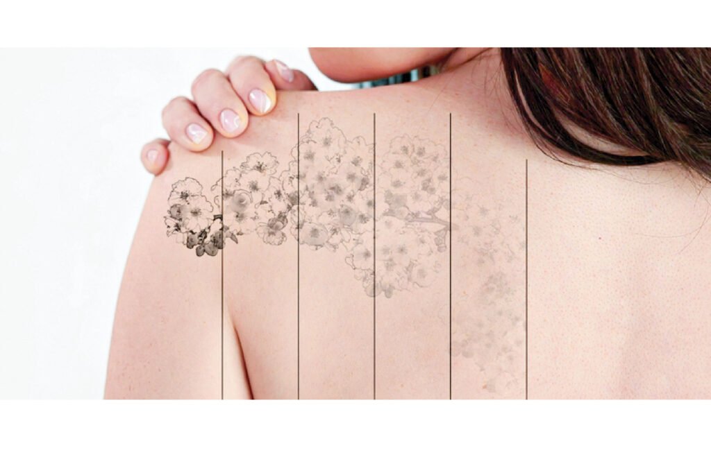 Menghilangkan tato adalah proses yang bisa memerlukan waktu, biaya, dan kesabaran.